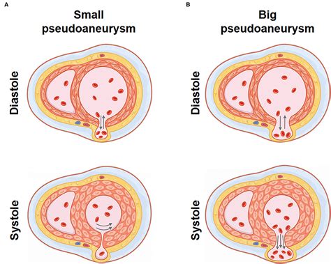 lv pseudoaneurysm|is pseudoaneurysm life threatening.